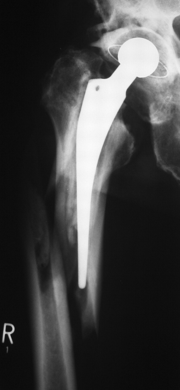 The Use Of Uncemented Extensively Porous-coated Femoral Components In ...