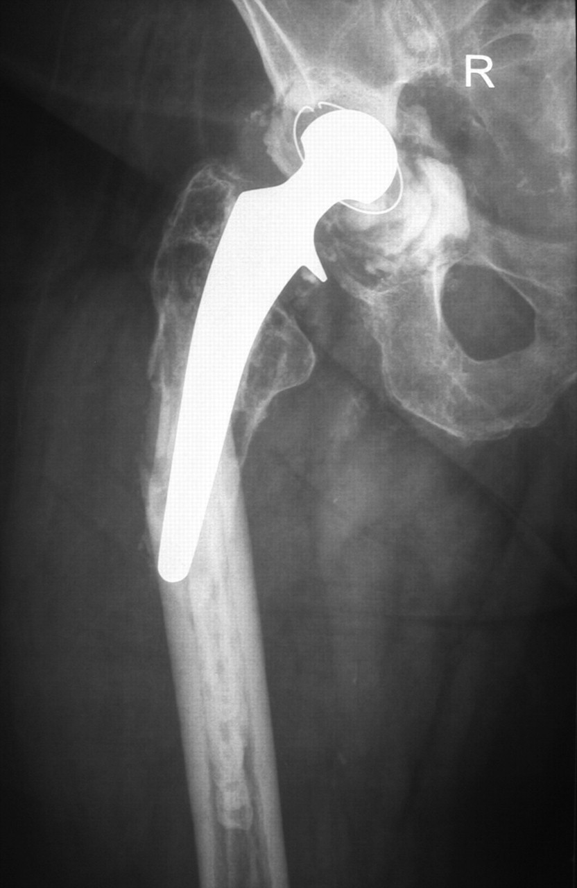 The Use Of Uncemented Extensively Porous-coated Femoral Components In ...