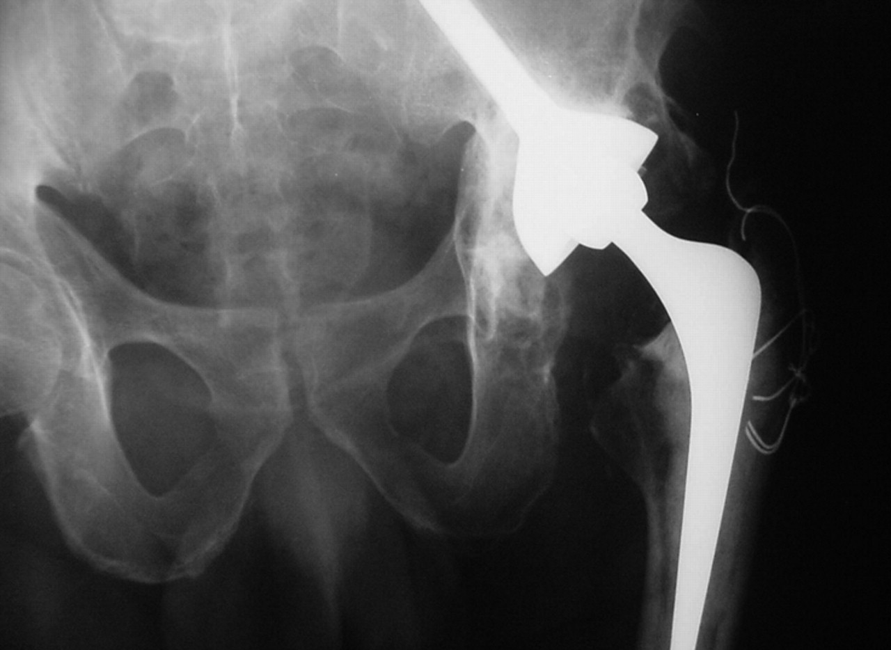 A Stemmed Acetabular Component In The Management Of Severe Acetabular ...