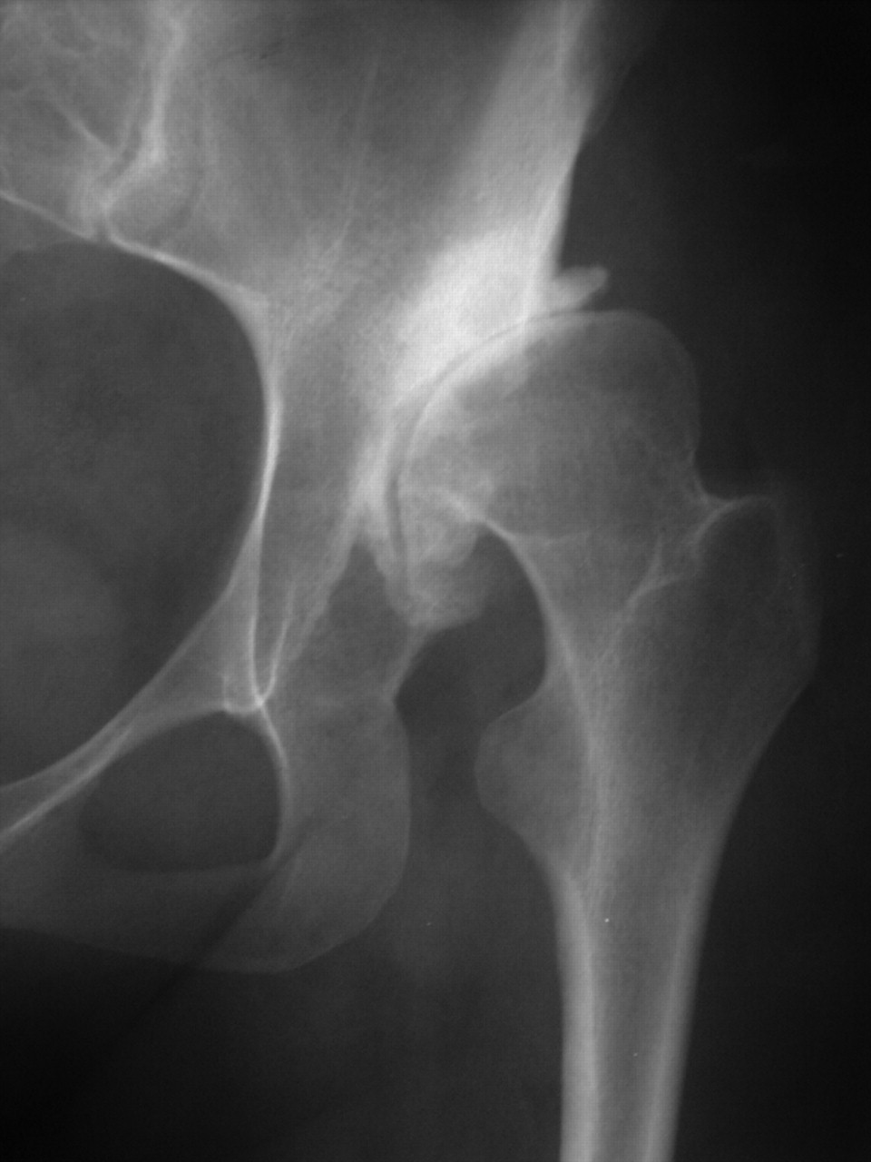 A stemmed acetabular component in the management of severe acetabular ...