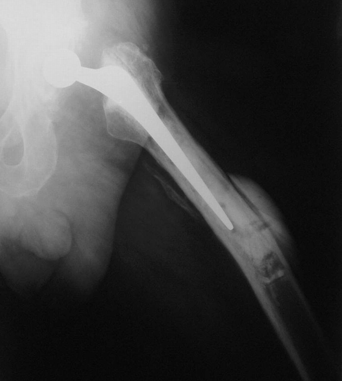 Histology of vancomycin-supplemented impacted bone allografts in ...