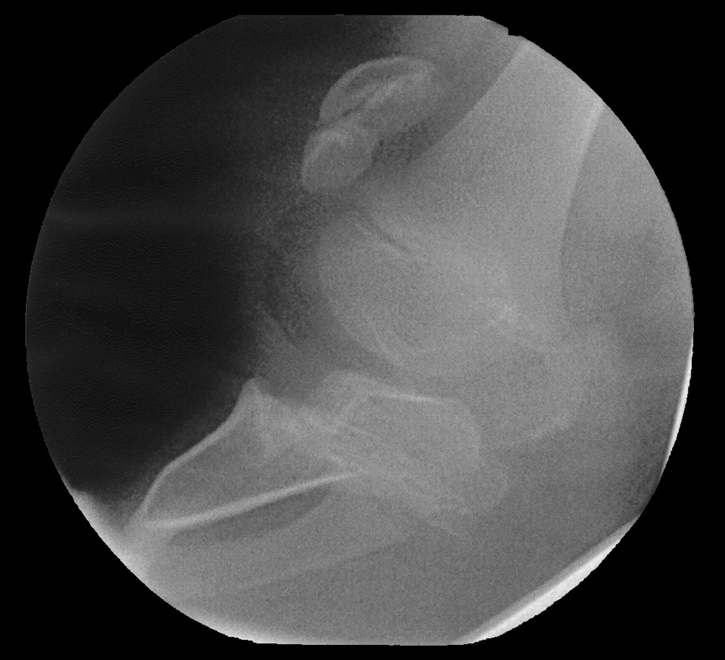 Late Orthopaedic Sequelae Following Meningococcal Septicaemia Bone