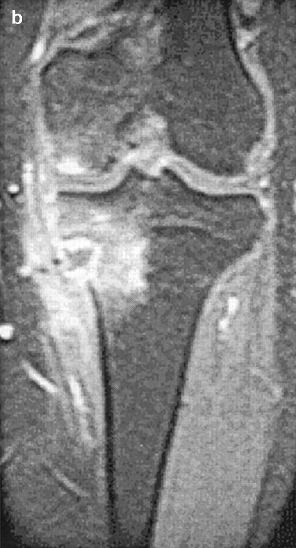 Reconstruction using an autograft containing tumour treated by liquid ...