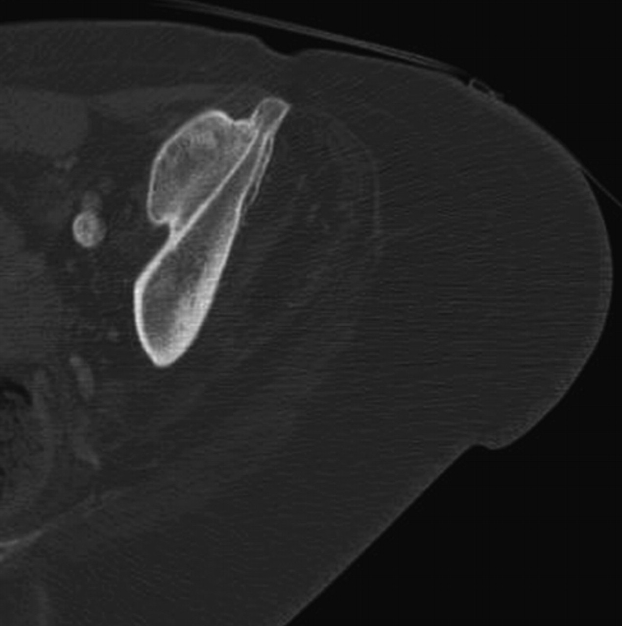 Ankylosing neurogenic myositis ossificans of the hip | Bone & Joint