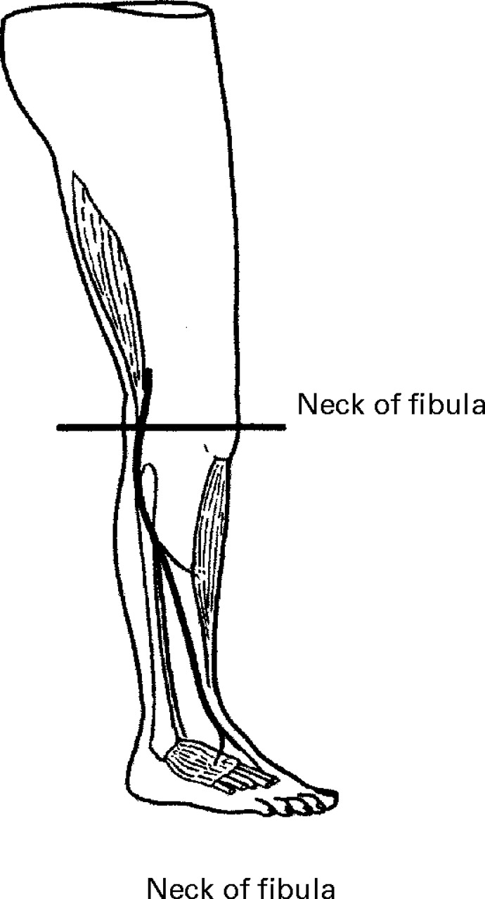 Double-crush syndrome after acetabular fractures | Bone & Joint