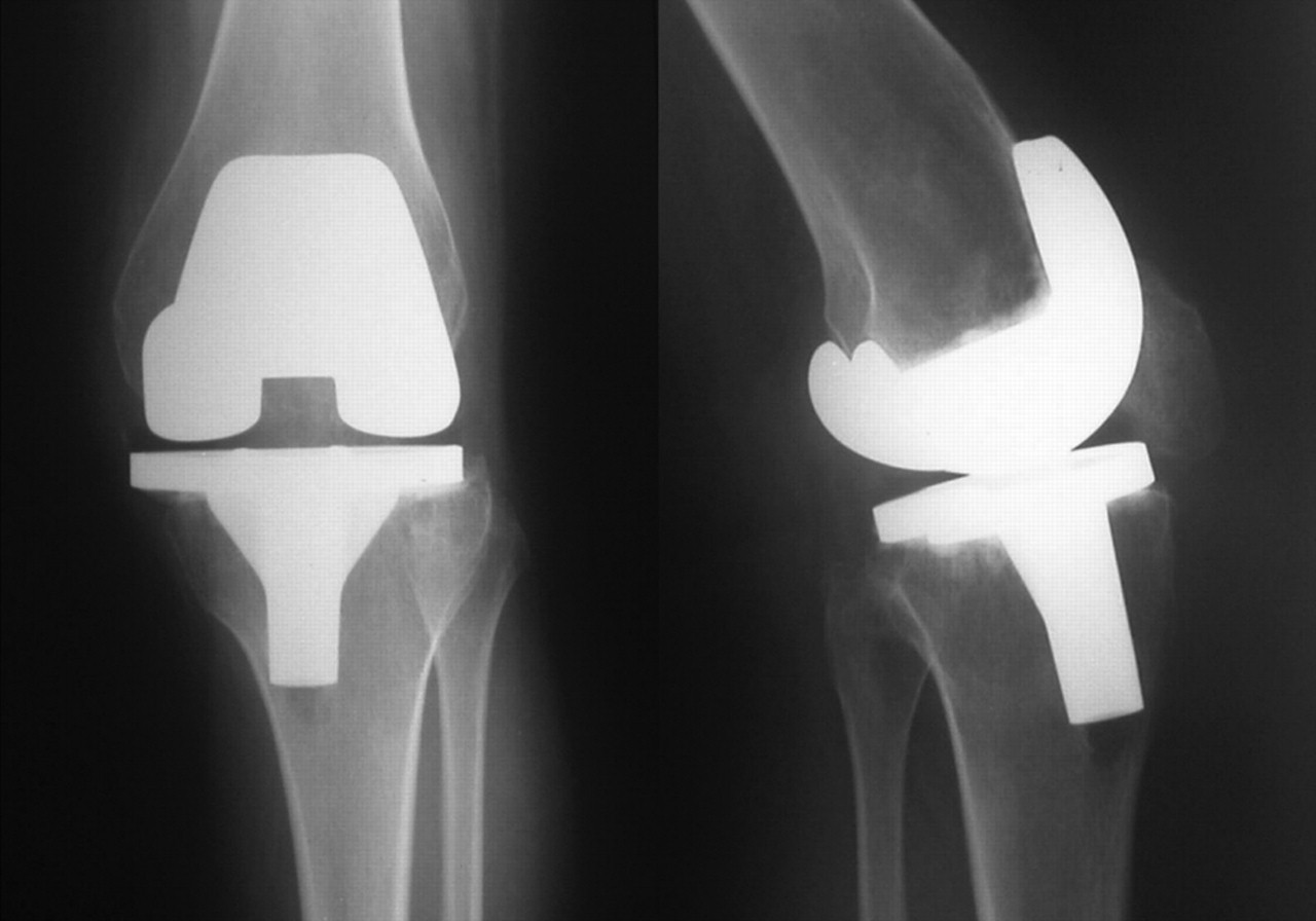 Total knee arthroplasty in stiff knees after previous infection | Bone ...