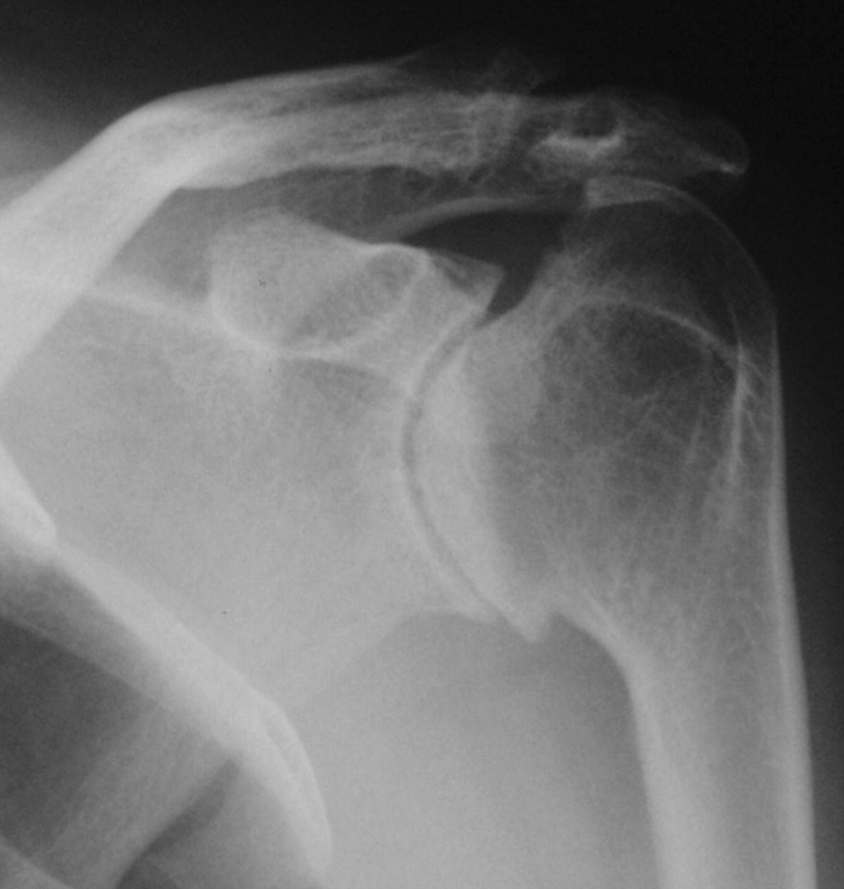 Shoulder hemiarthroplasty in patients with juvenile idiopathic ...