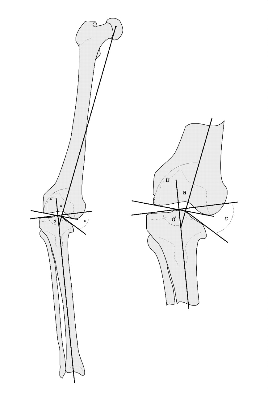 Double-elevating osteotomy for late-presenting infantile Blount’s ...