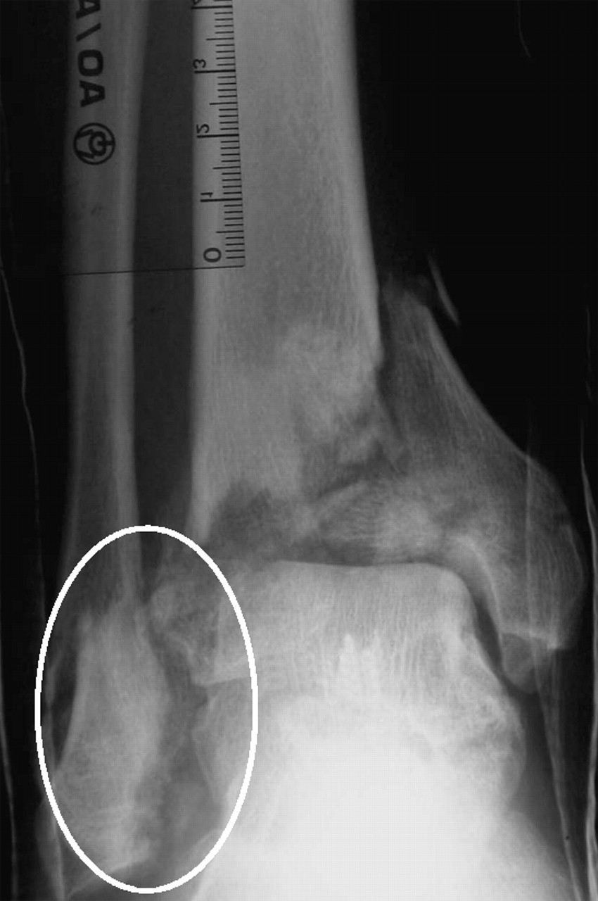 Anatomy Of Pilon Fractures Of The Distal Tibia Bone And Joint