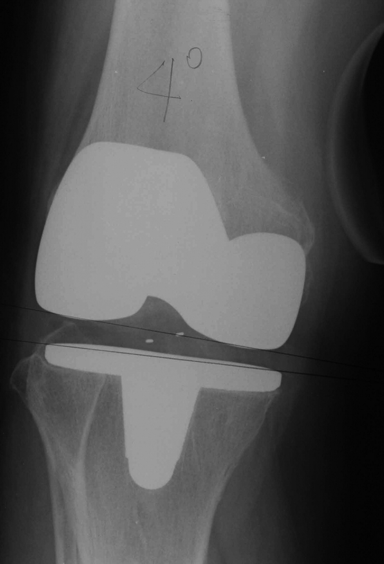 Varus-valgus balance and range of movement after total knee ...