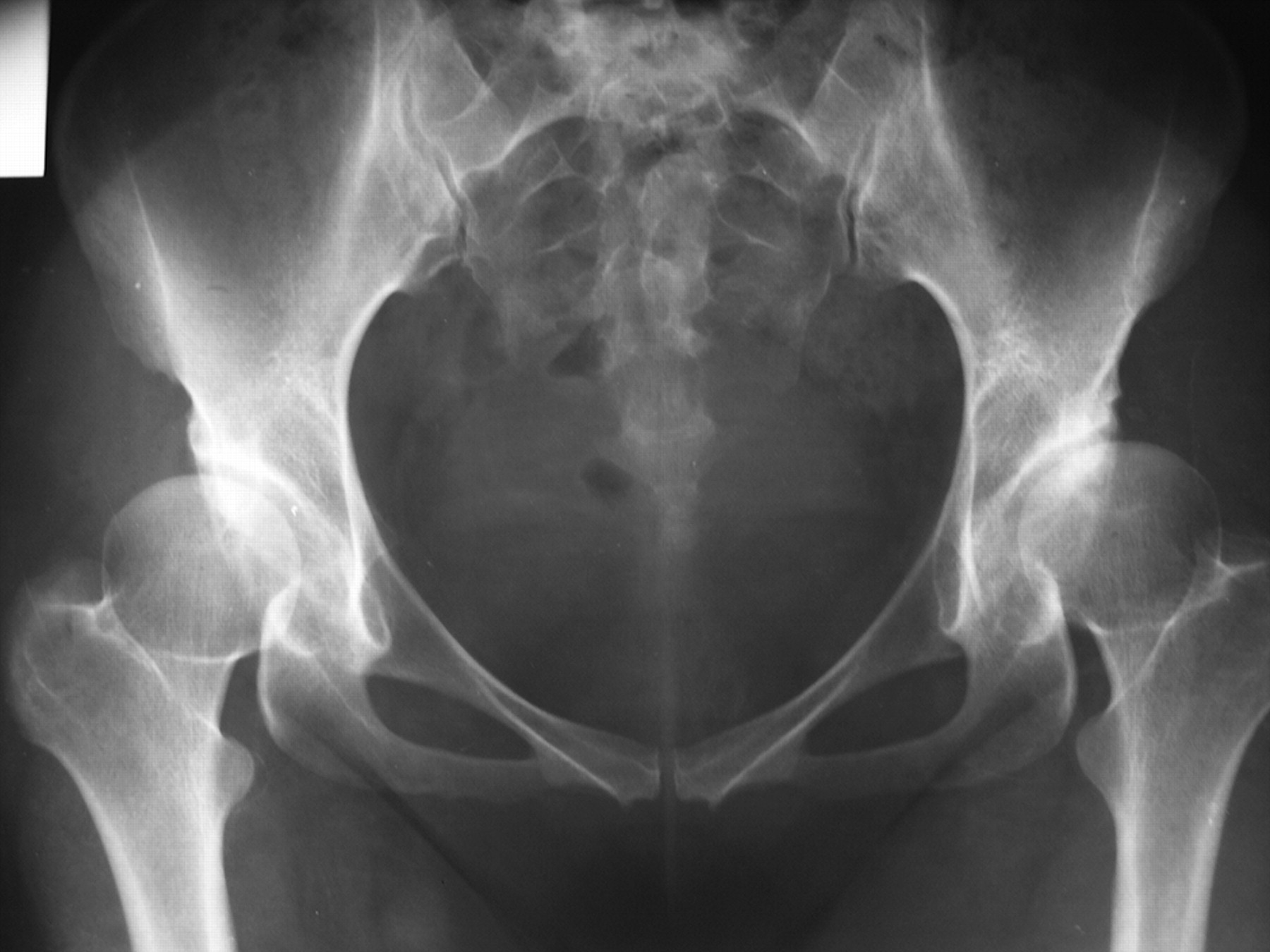 Incomplete triple pelvic osteotomy for the surgical treatment of ...