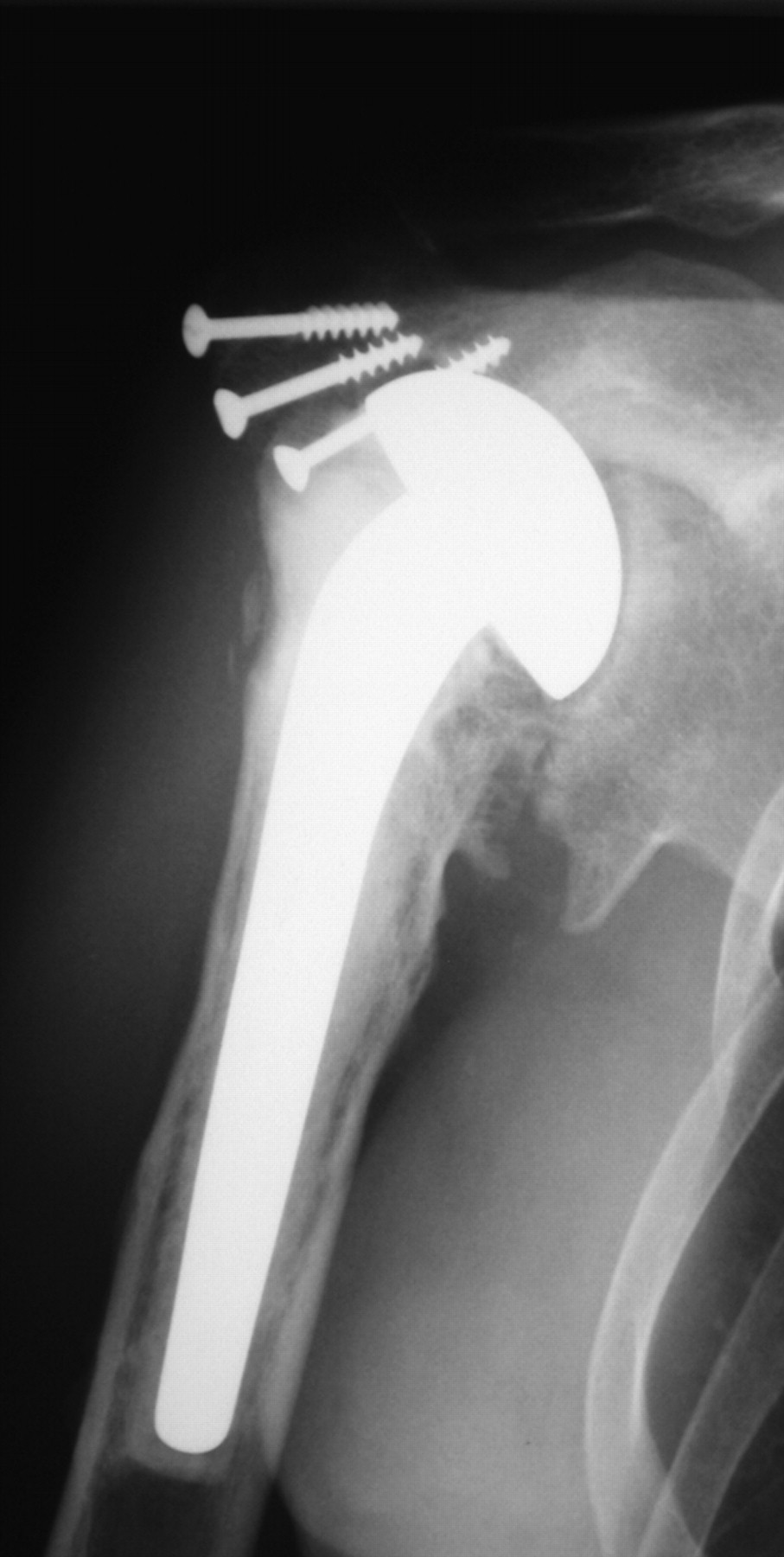 One-stage exchange shoulder arthroplasty for peri-prosthetic infection ...