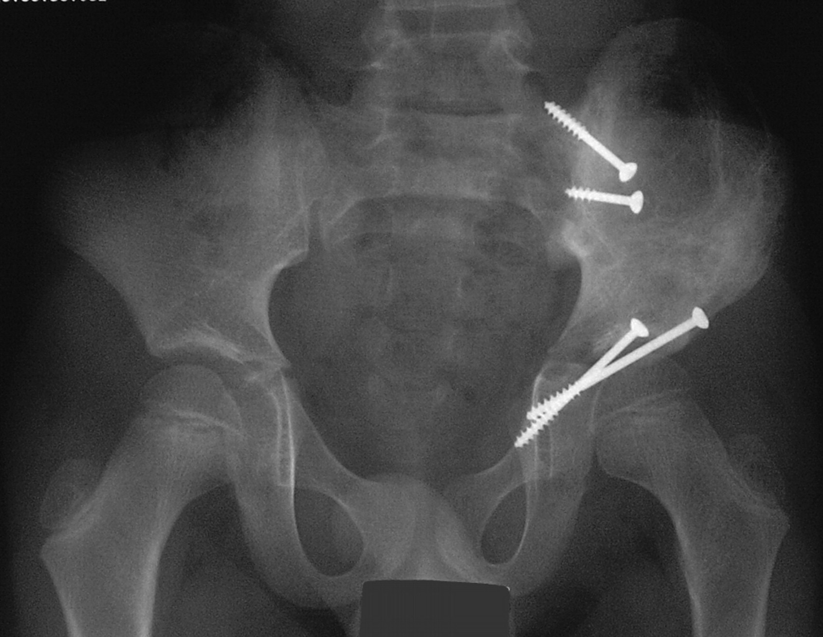 En-bloc resection, extracorporeal irradiation, and re-implantation in ...