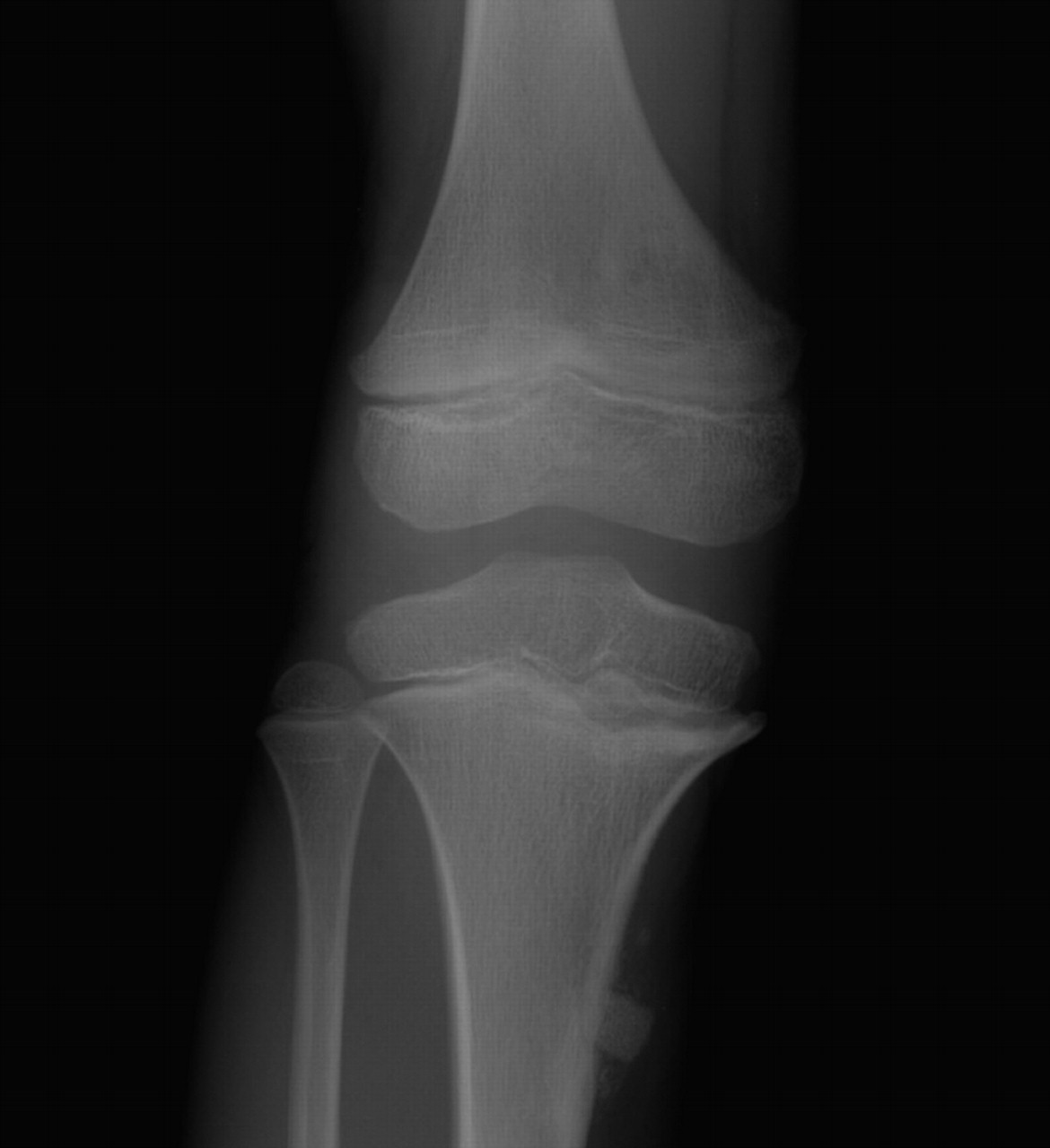 Regeneration of the proximal tibial epiphysis after infantile ...