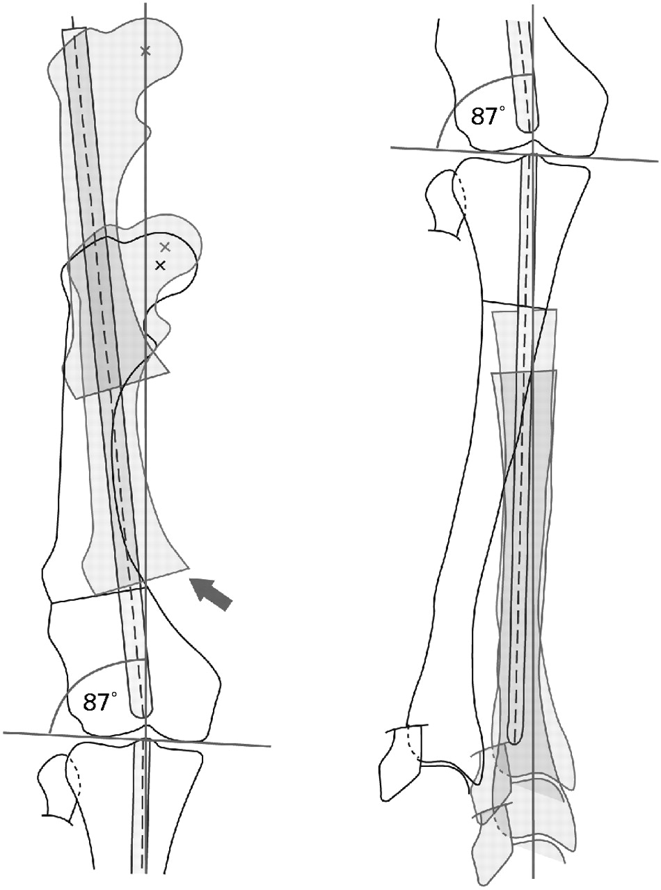 The management of leg-length discrepancy in Ollier’s disease with a ...