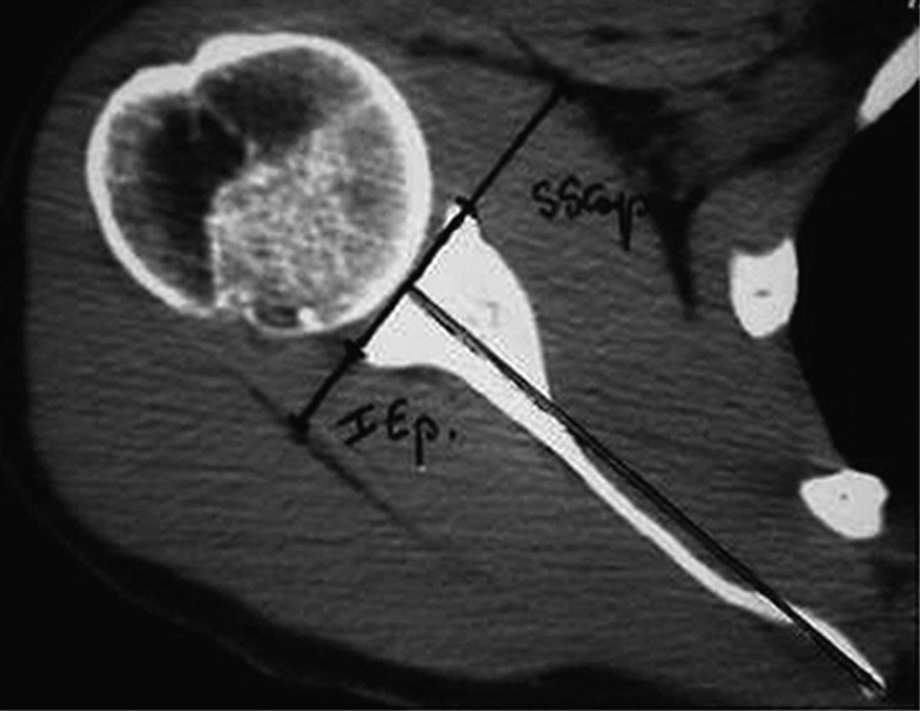 function-of-subscapularis-after-surgical-treatment-for-recurrent