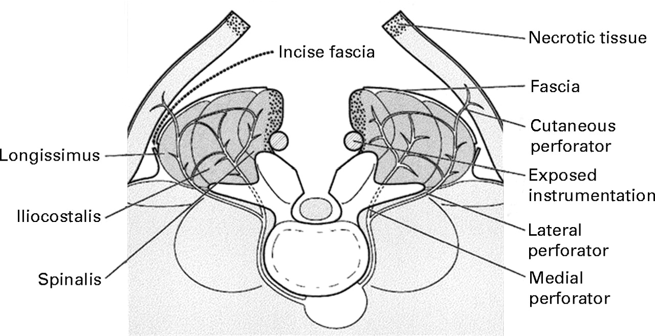 The management of complex soft-tissue defects after spinal ...