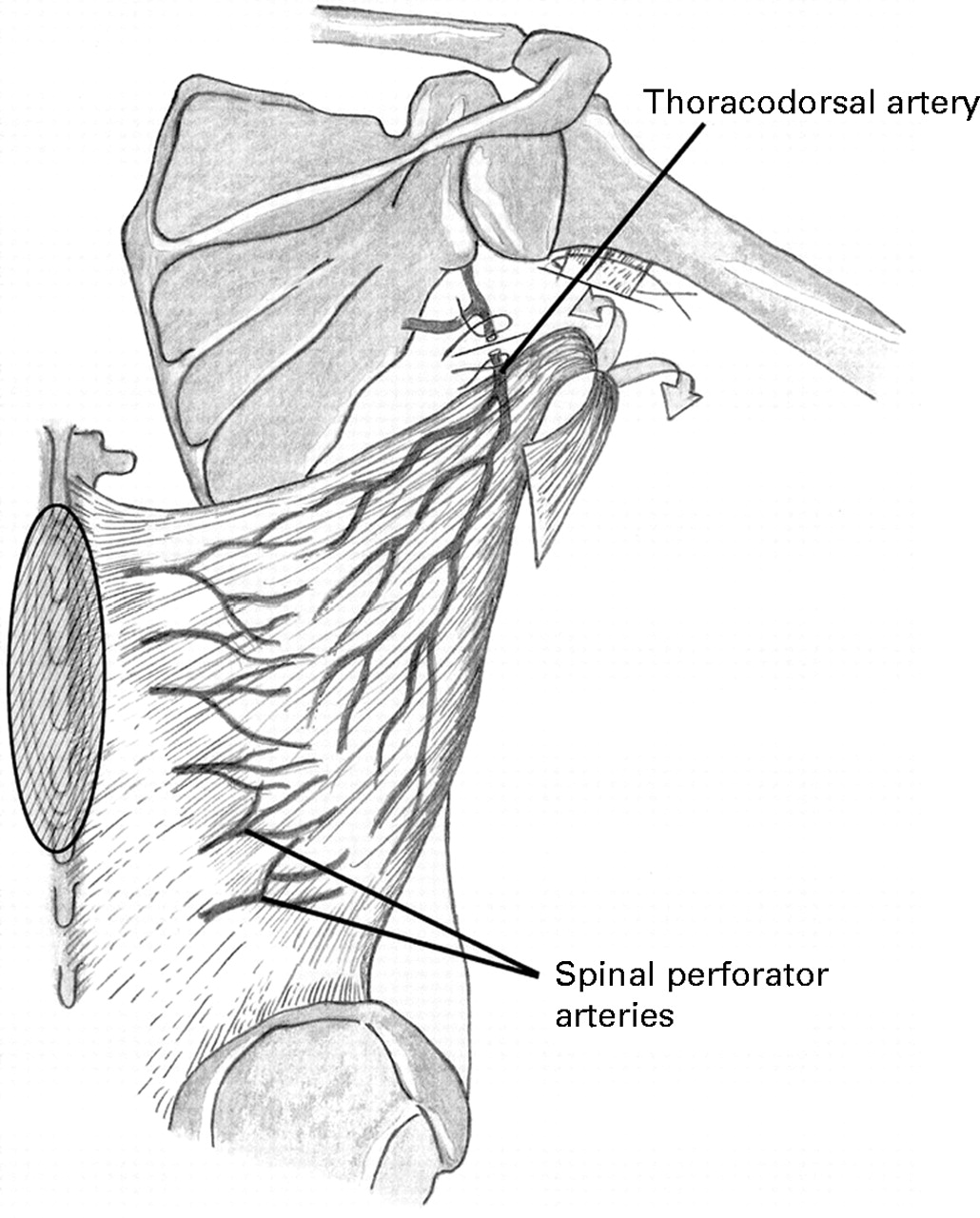 Reverse Bilateral Latissimus Dorsi Flap Reconstructio - vrogue.co