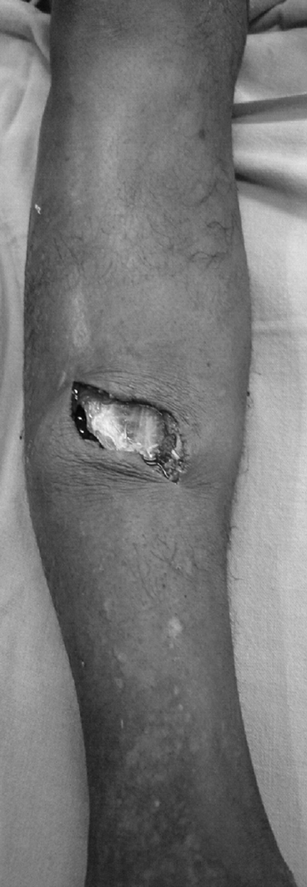 CRUSH INJURY FOOT, LOWER LIMB INJURIES AND LIMB SALVAGE: DEEP FRICTION BURNS  WITH SOFT TISSUE LOSS - DEBRIDEMENT AND SKIN GRAFTING 