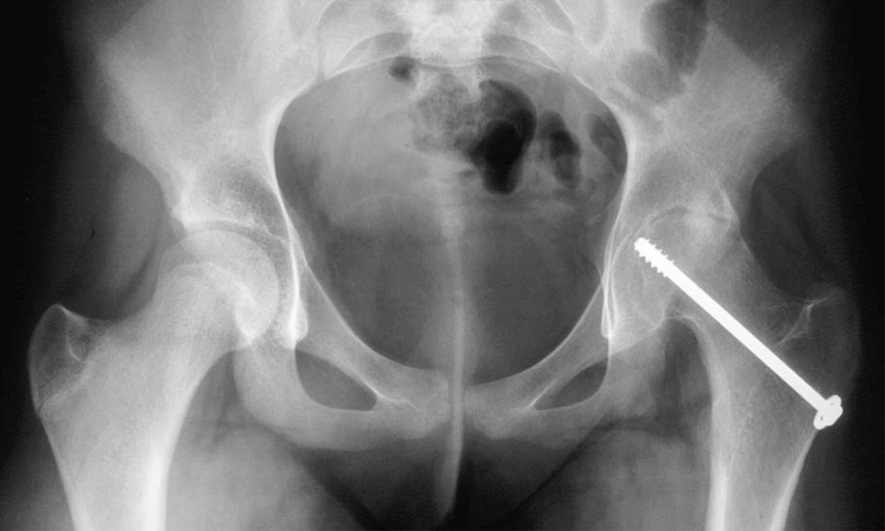 The contralateral slip | Bone & Joint