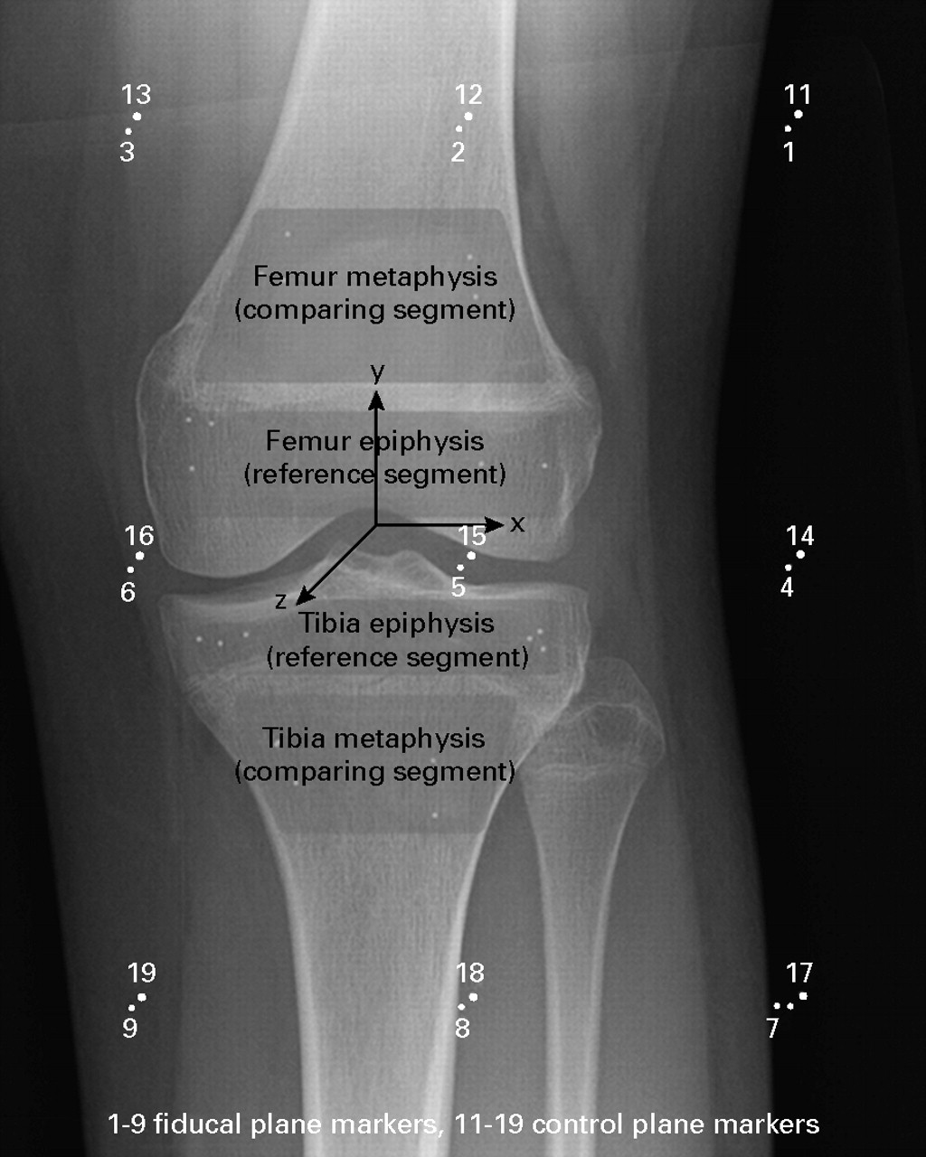 Radiostereometric analysis for monitoring percutaneous physiodesis ...