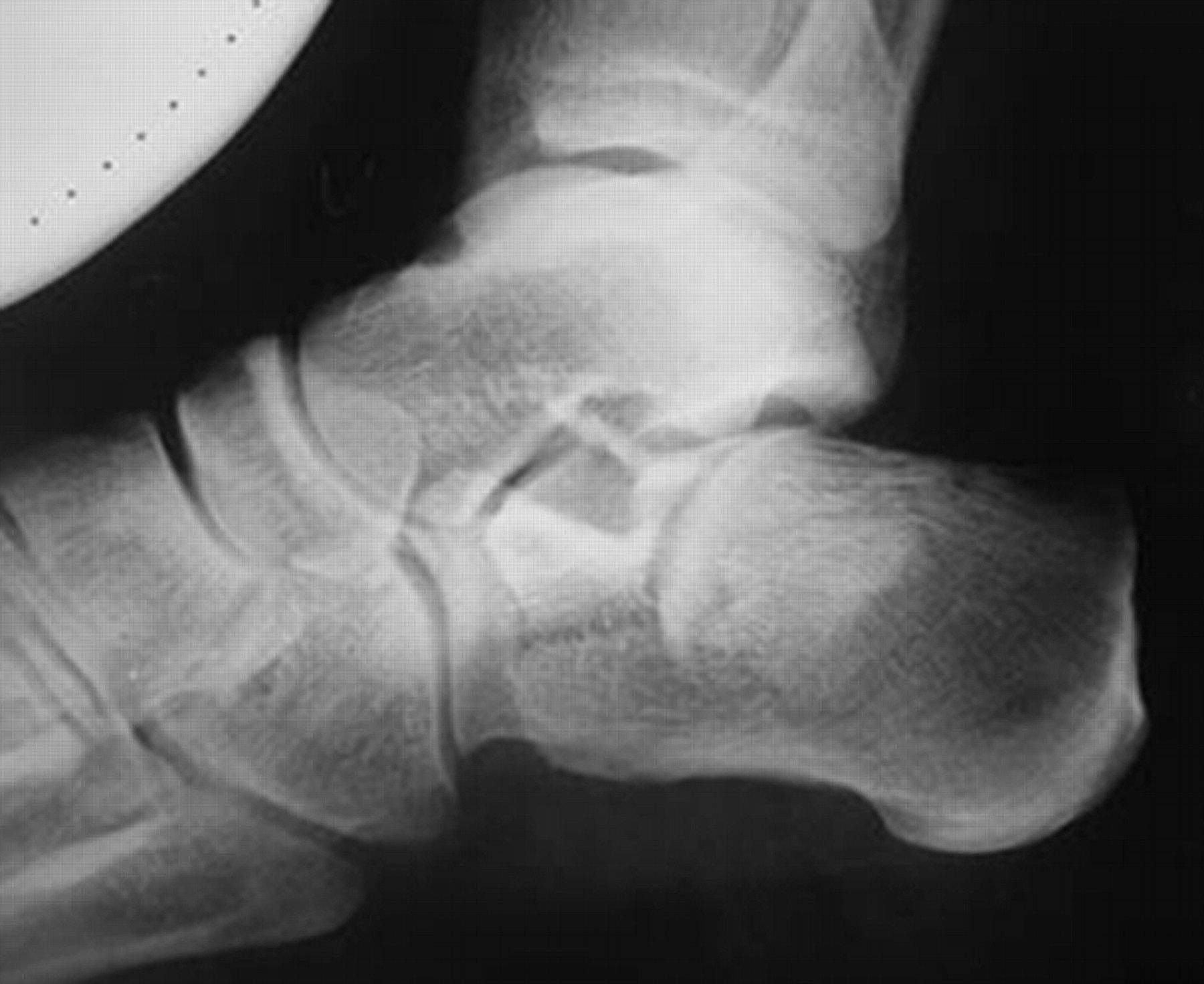 External fixation for displaced intra-articular fractures of the ...