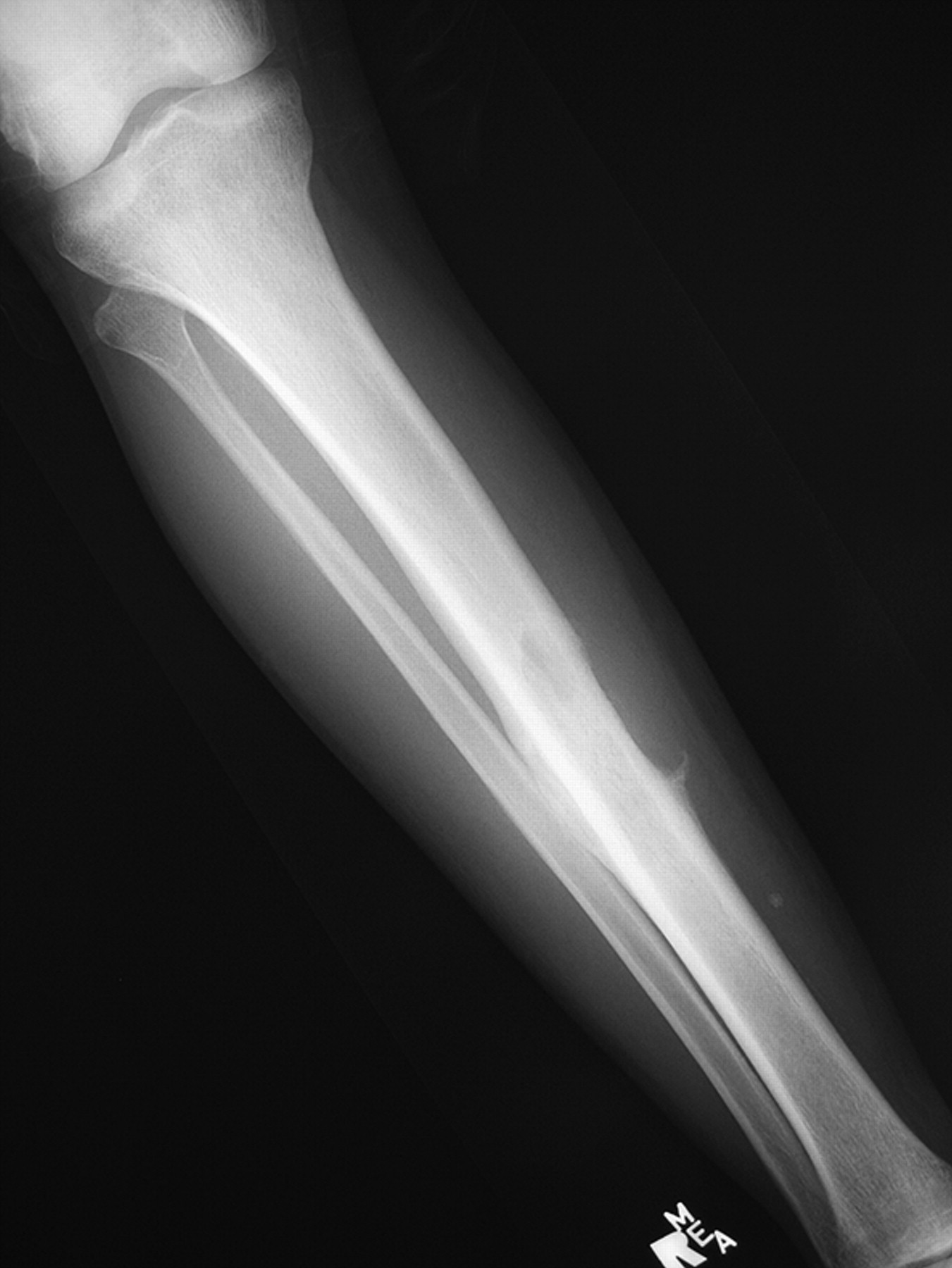 Intercalary endoprosthetic reconstruction for diaphyseal bone tumours ...