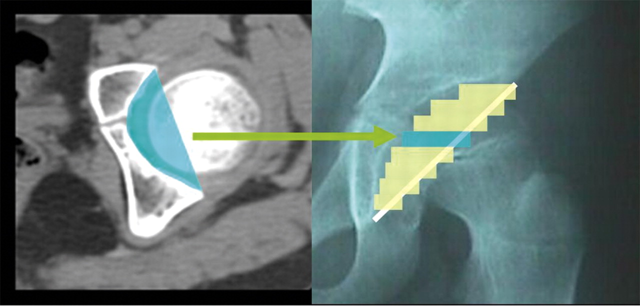 Morphometric Analysis Of Acetabular Dysplasia In Cerebral Palsy Bone