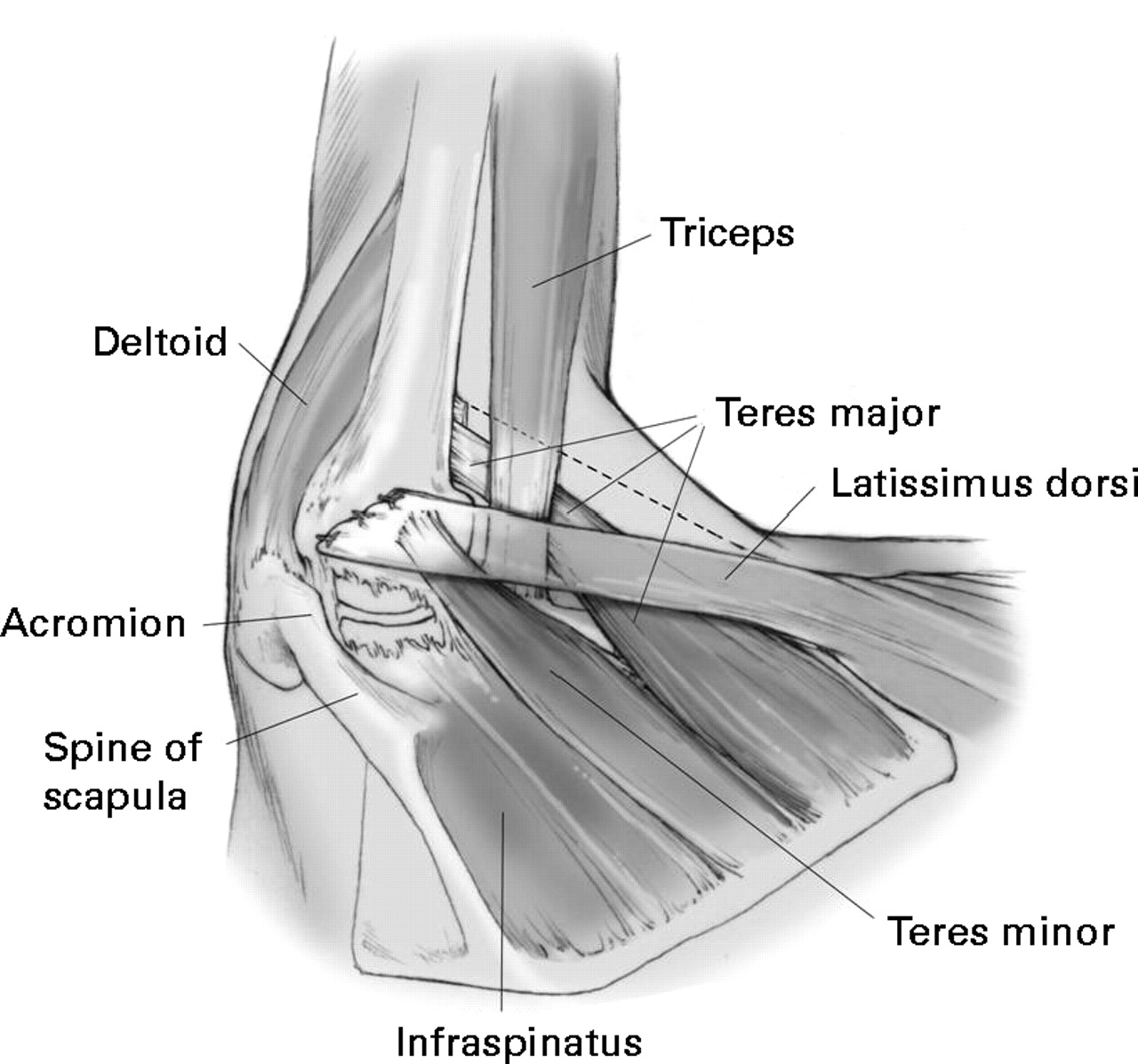 Transfer of the tendon of latissimus dorsi for the treatment of massive ...