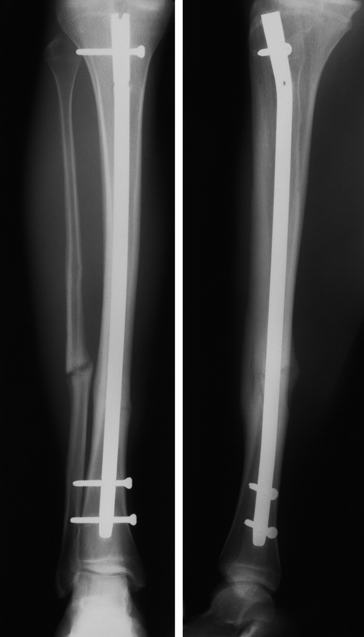 Management of severe open tibial fractures | Bone & Joint