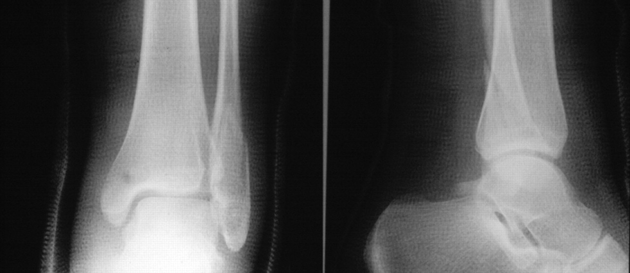 Fatal pulmonary embolism following ankle fracture in a 17-year-old girl ...