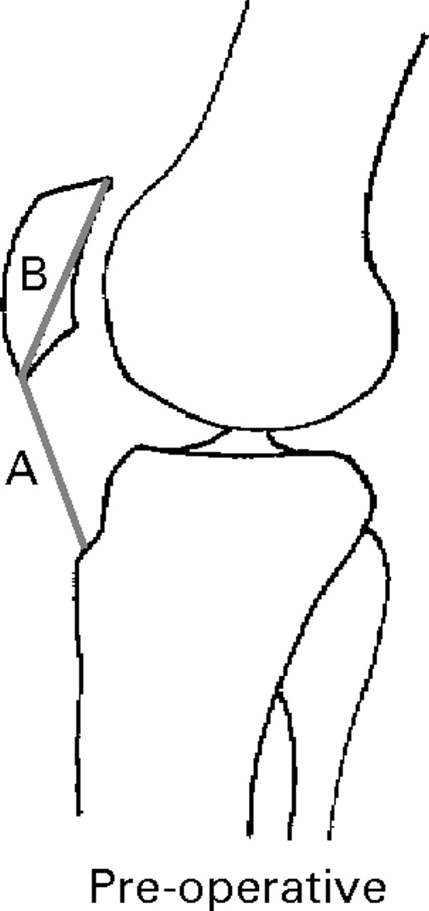 Interobserver Variation In The Measurement Of Patellar Height After ...