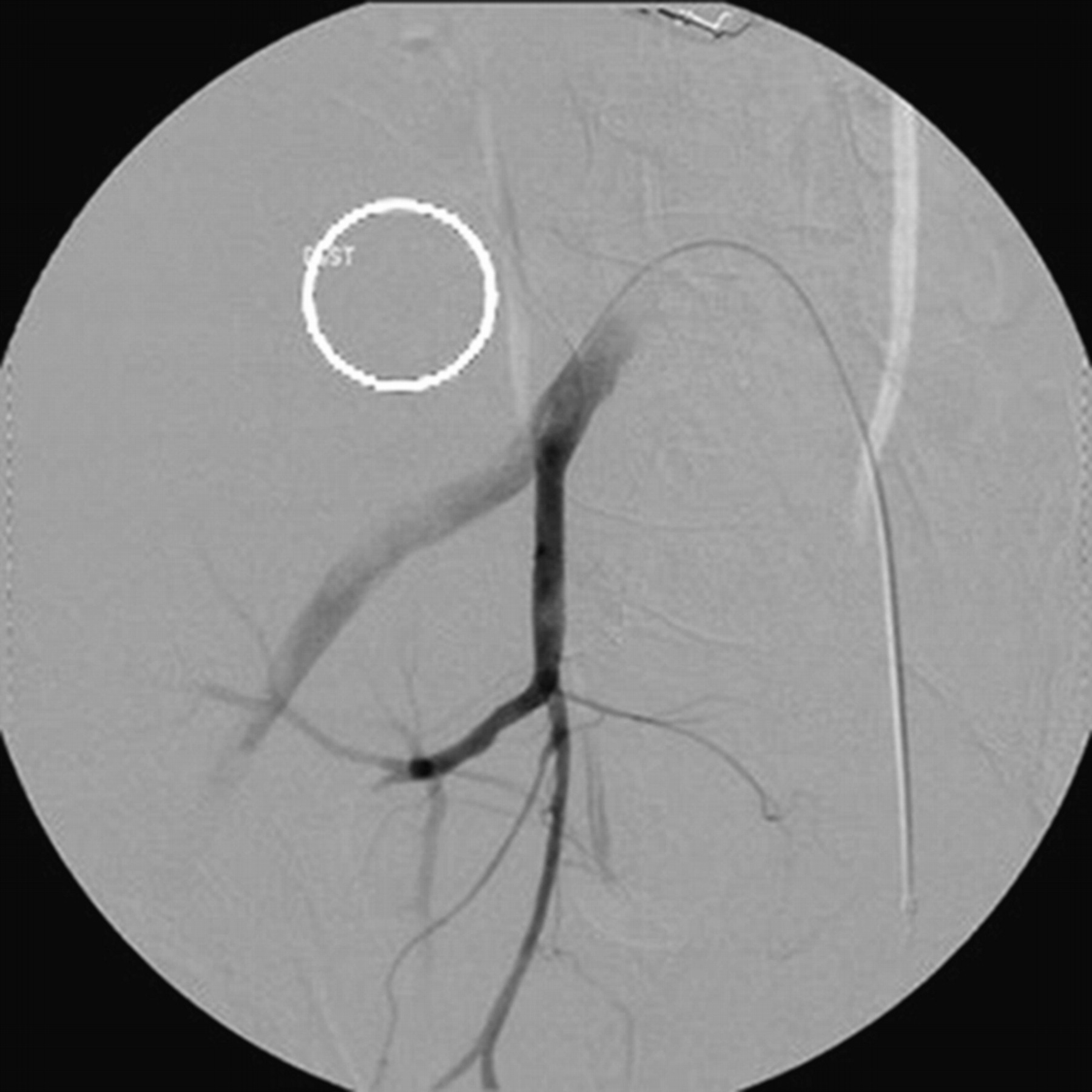 An Unstable Pelvic Ring | Bone & Joint