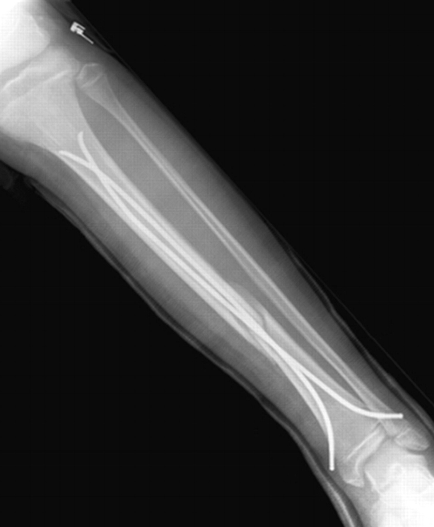 Flexible intramedullary nails for unstable fractures of the tibia in ...