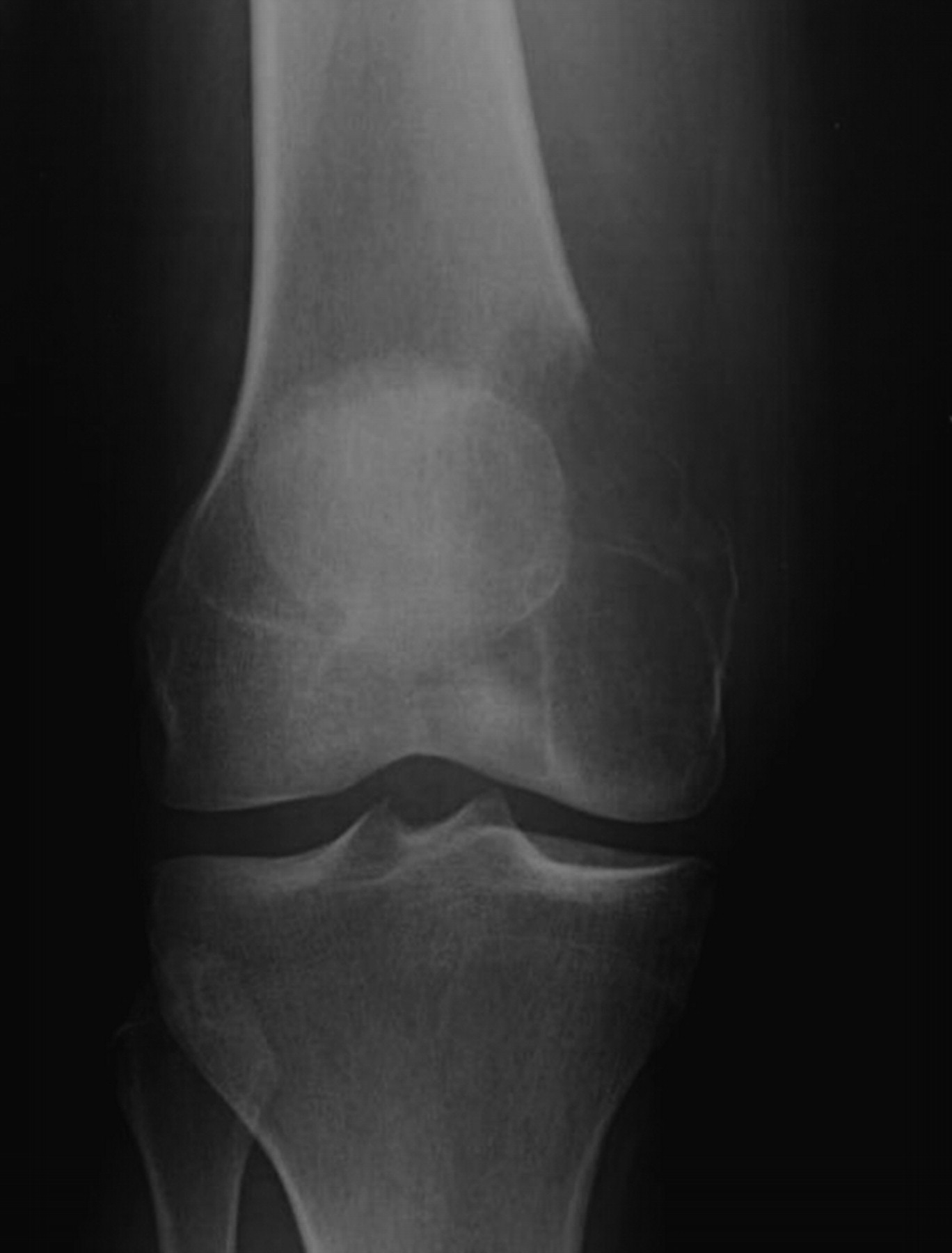 Treatment of local recurrences of giant cell tumour in long bones after ...