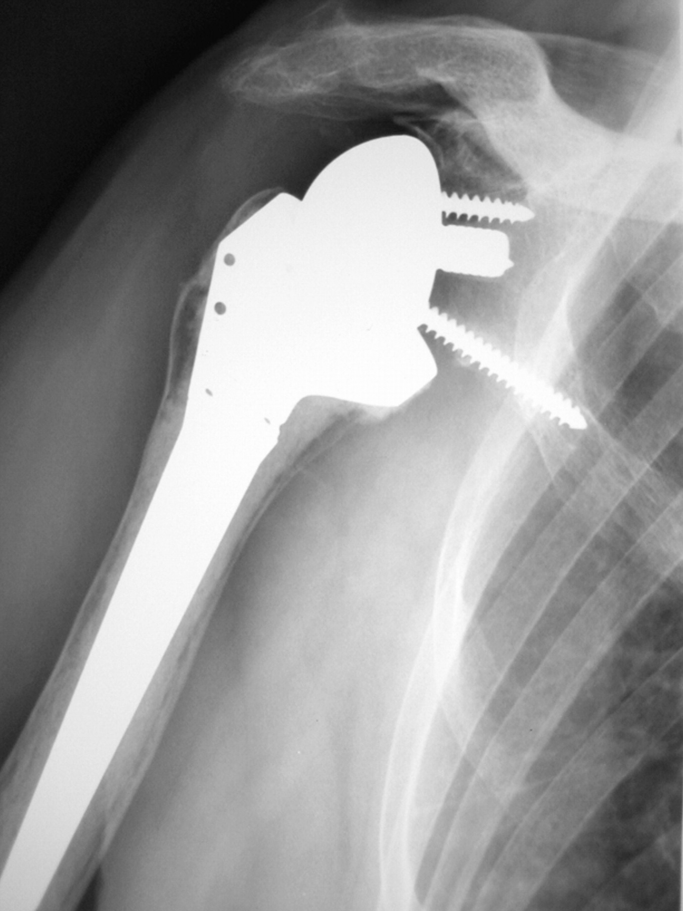 Arthroplasty of the shoulder | Bone & Joint