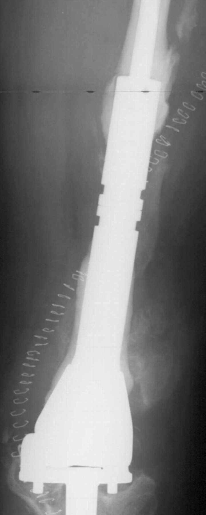 Non-invasive Distal Femoral Expandable Endoprosthesis For Limb-salvage ...