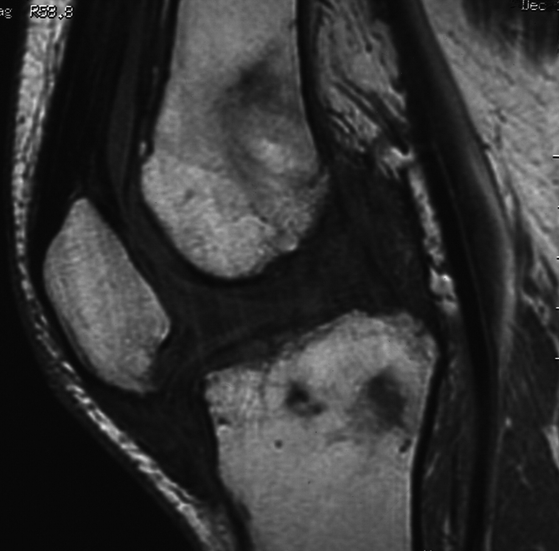 Recurrent synovial chondromatosis of the knee after radical synovectomy ...