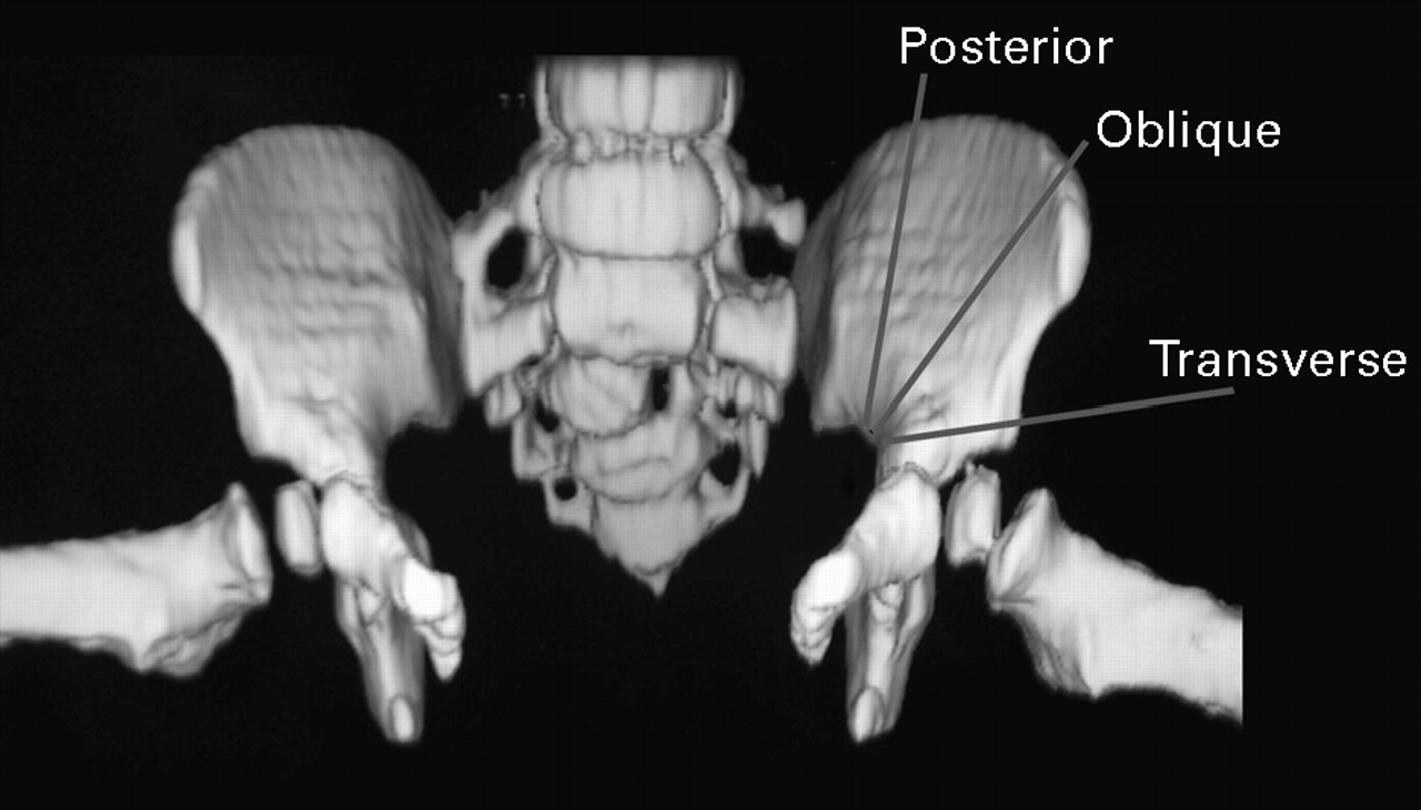 Oblique Pelvic Osteotomy In The Exstrophyepispadias Complex Bone And Joint