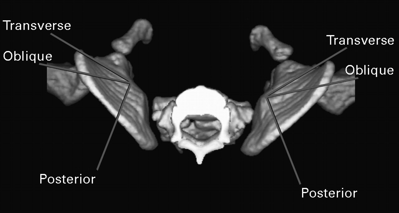 Oblique pelvic osteotomy in the exstrophy/epispadias complex | Bone & Joint