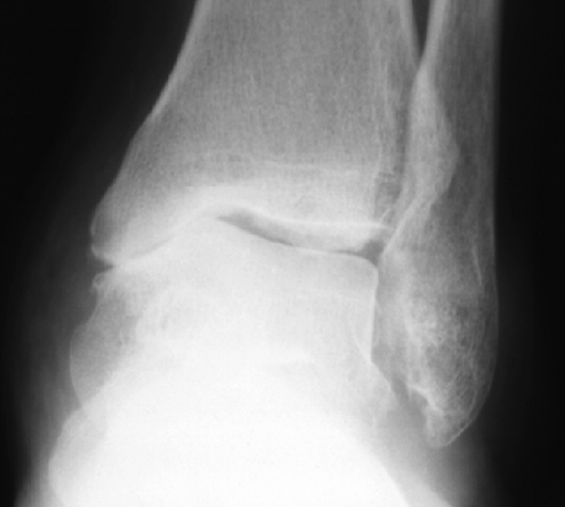 Low tibial osteotomy for varus-type osteoarthritis of the ankle | Bone ...