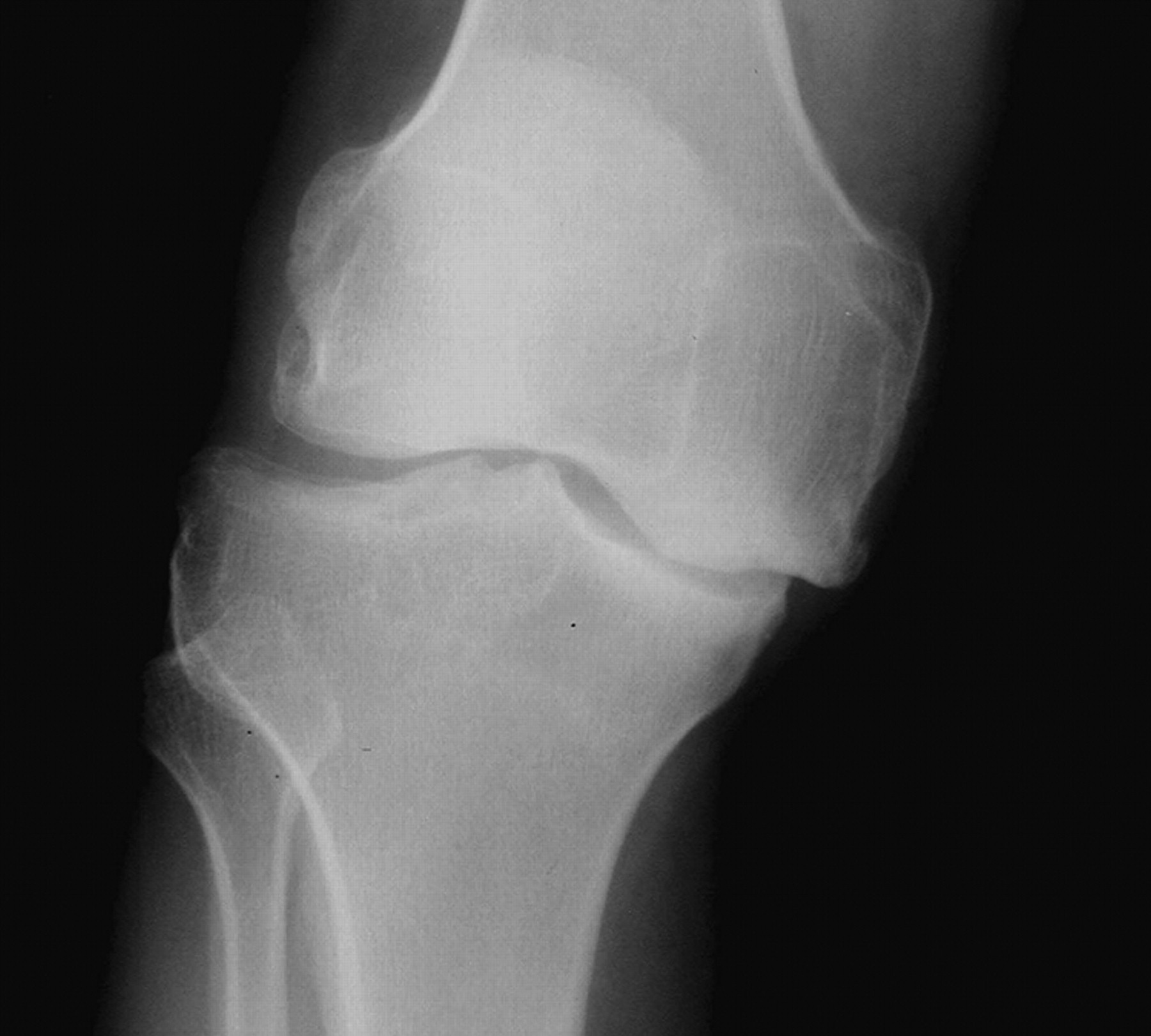 Combined anterior cruciate reconstruction and Oxford unicompartmental ...