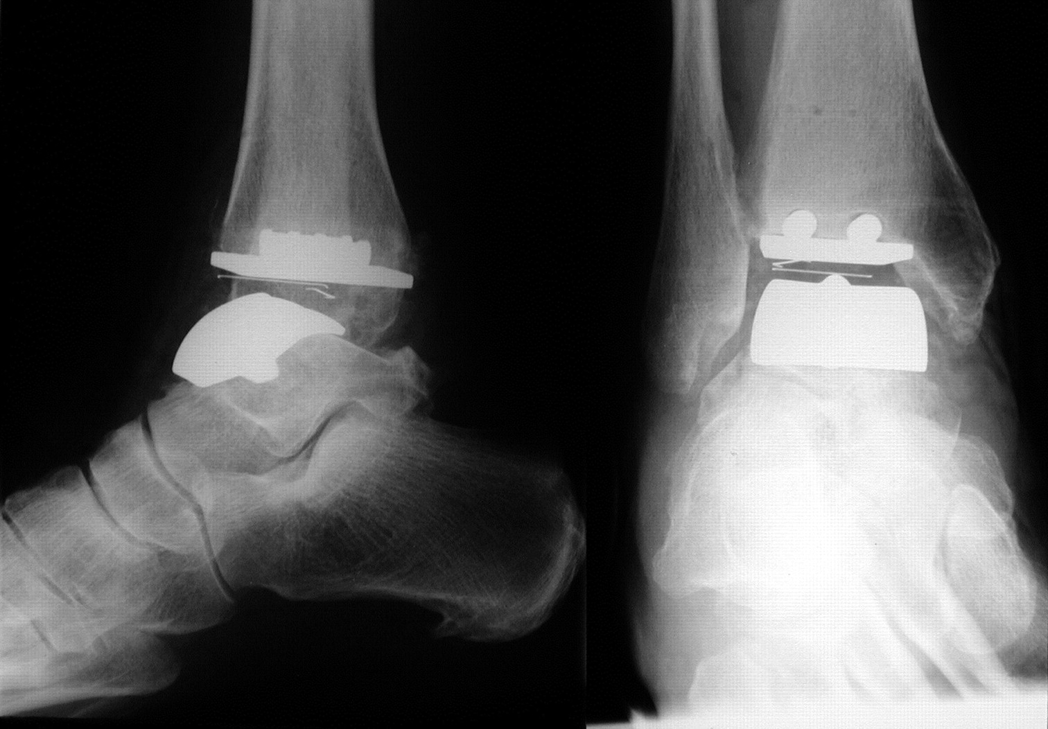 The management of failed ankle replacement | Bone & Joint