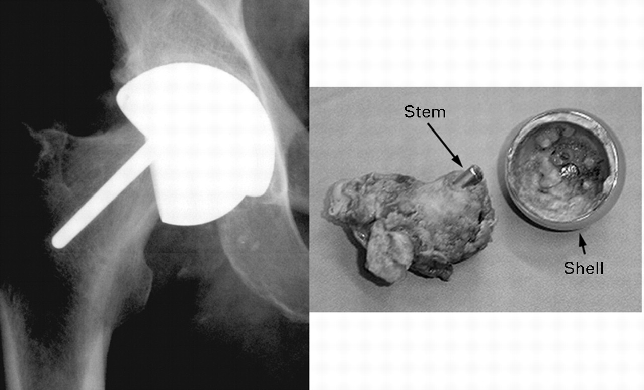 Biomechanics of the Birmingham hip resurfacing arthroplasty | Bone & Joint