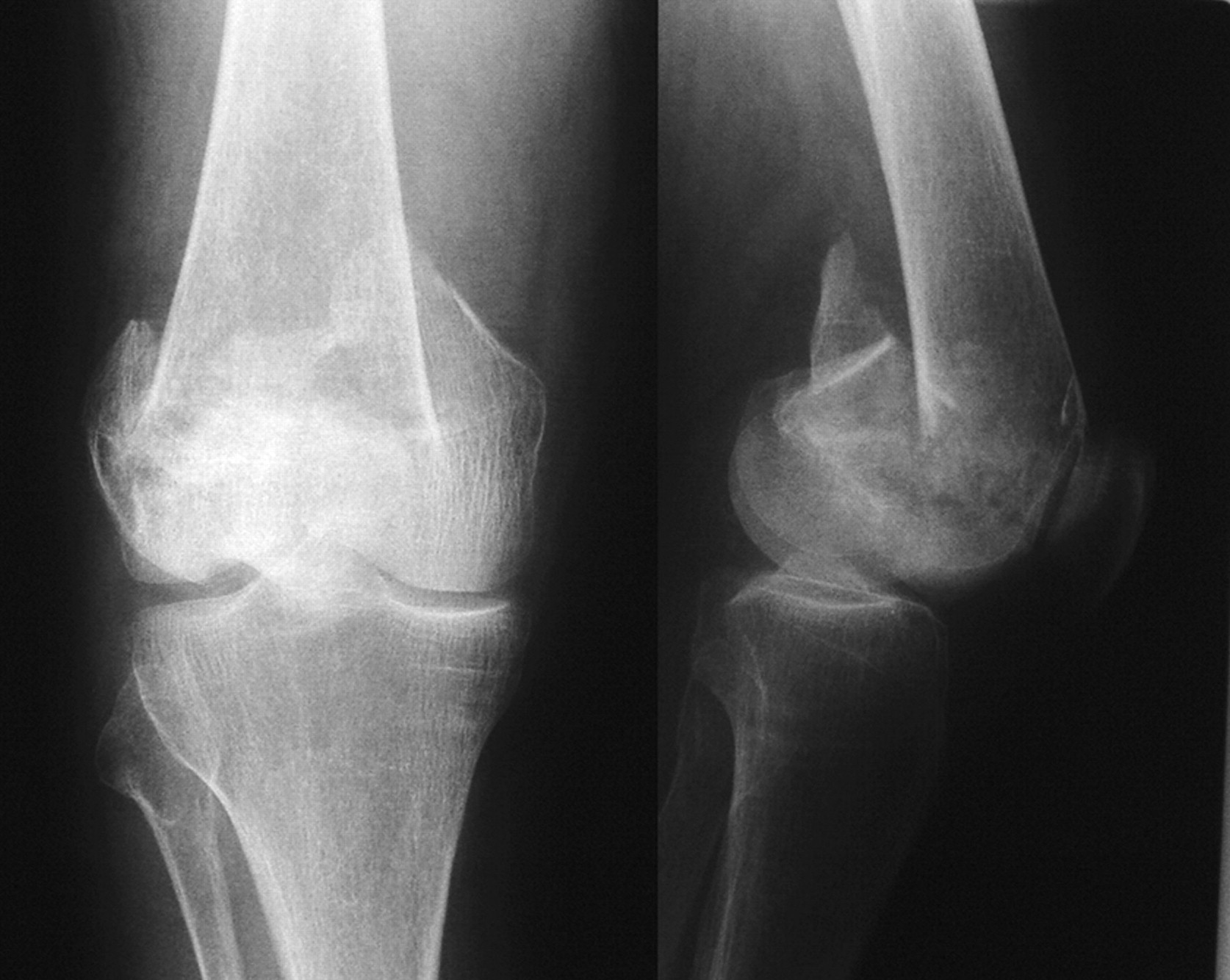 Distal Femoral Fractures Treated By Hinged Total Knee Replacement In 