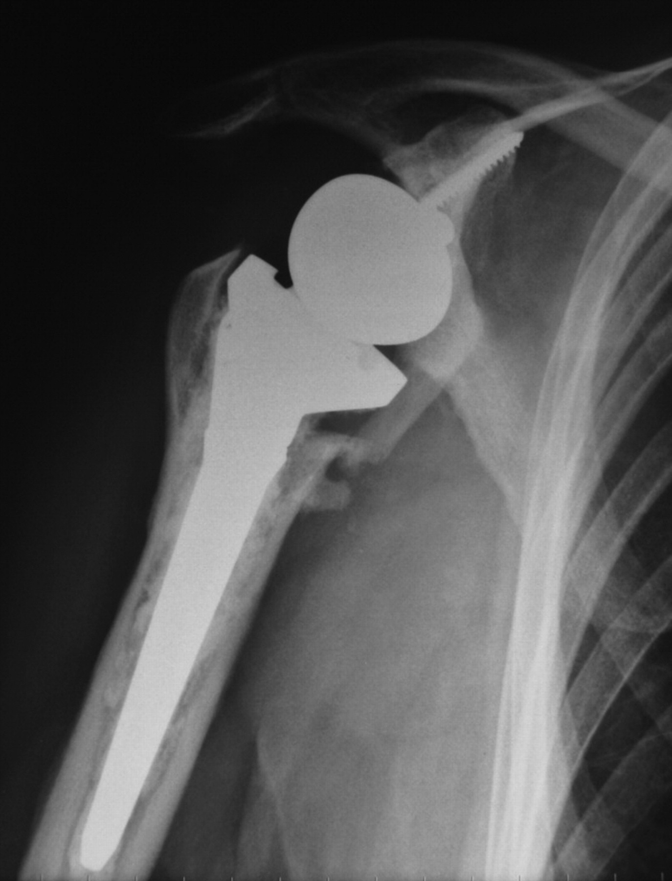 Use of freeze-dried bone allograft with platelet-derived growth factor ...