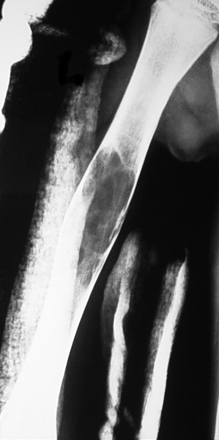 Treatment Of Aneurysmal Bone Cysts With Percutaneous Sclerotherapy Using Polidocanol Bone And Joint 5460