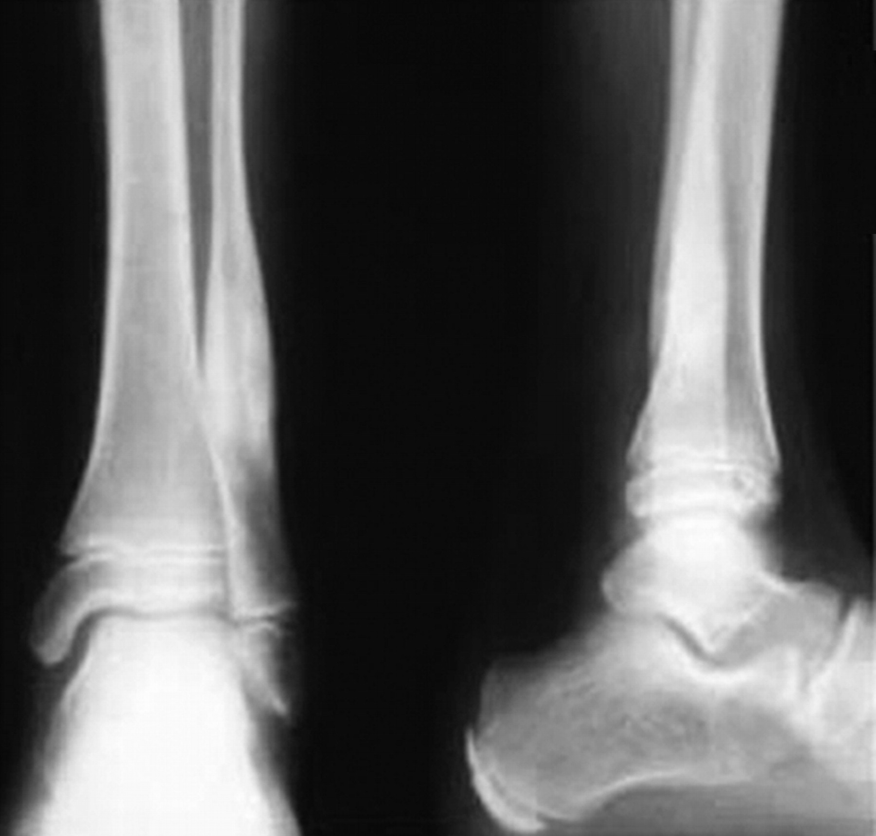 Treatment Of Aneurysmal Bone Cysts With Percutaneous Sclerotherapy