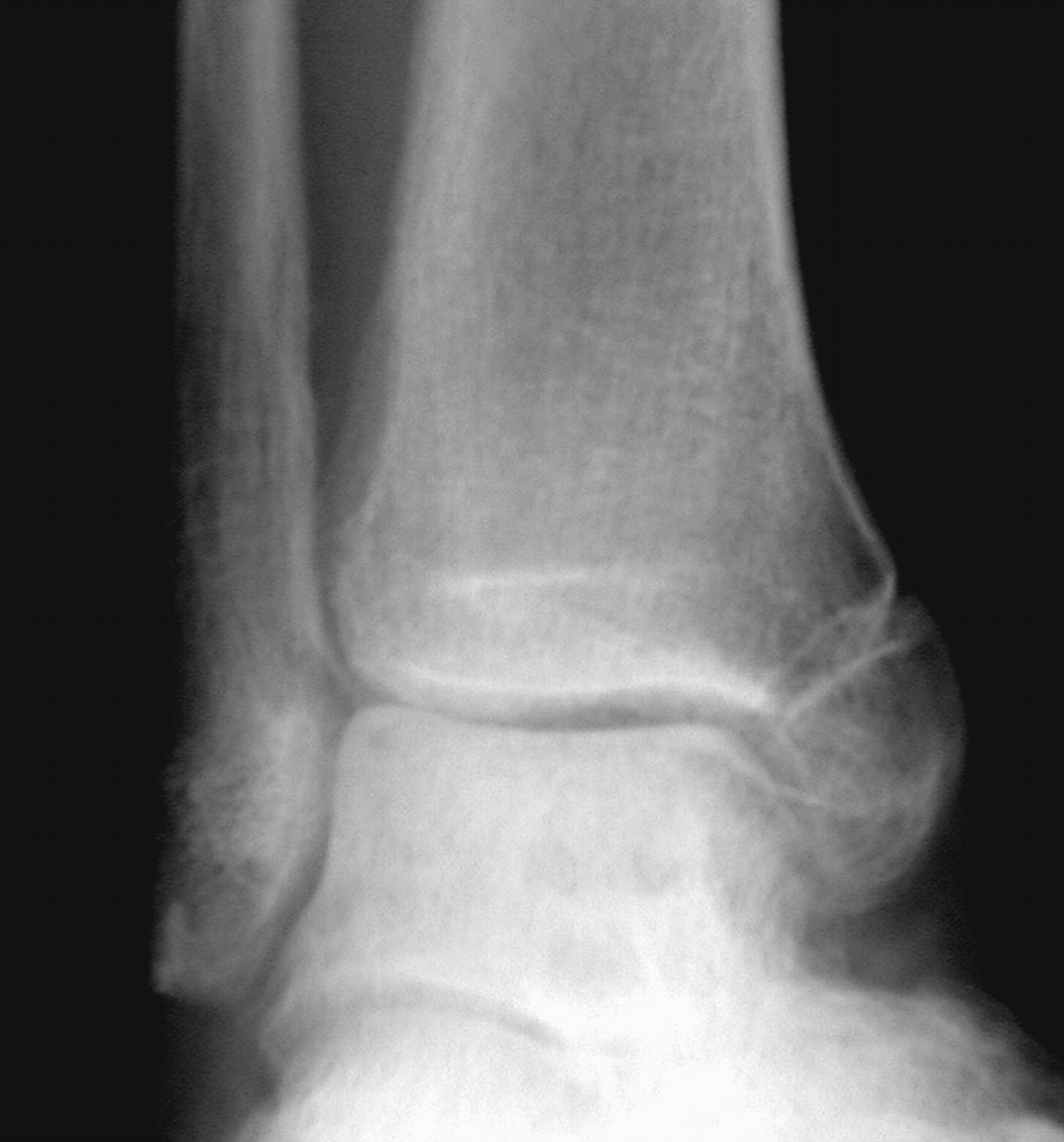 conservative-treatment-of-isolated-fractures-of-the-medial-malleolus