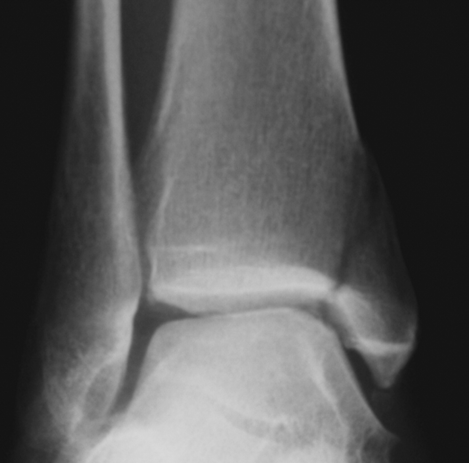 Conservative Treatment Of Isolated Fractures Of The Medial Malleolus Bone And Joint 3954